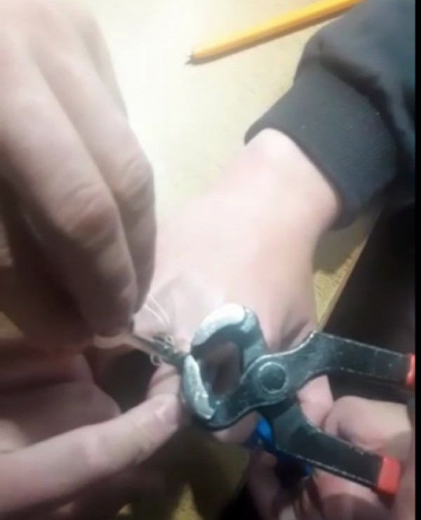 В Кривом Роге спасатели срезали подшипник с пальца ...