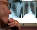 Украина получит около $100 млн. на борьбу с туберкулезом